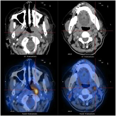 Syncope as the Initial Manifestation of Advanced Nasopharyngeal Carcinoma: A Case Report